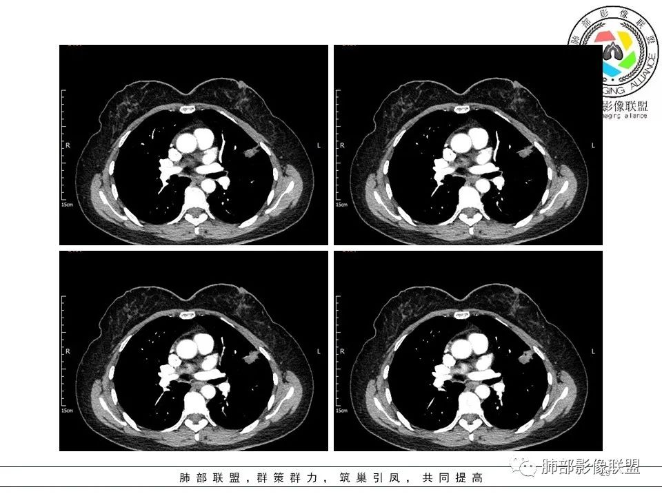 【病例】左肺上叶腺癌1例CT影像讨论 【病例】左肺上叶腺癌1例CT影像讨论