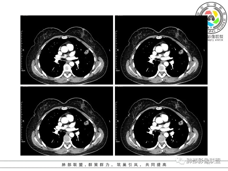 【病例】左肺上叶腺癌1例CT影像讨论 【病例】左肺上叶腺癌1例CT影像讨论