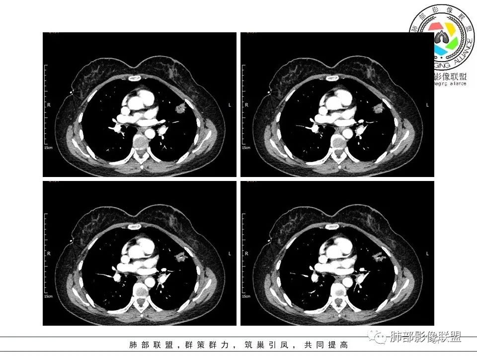 【病例】左肺上叶腺癌1例CT影像讨论 【病例】左肺上叶腺癌1例CT影像讨论