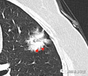 【病例】左肺上叶腺癌1例CT影像讨论 【病例】左肺上叶腺癌1例CT影像讨论