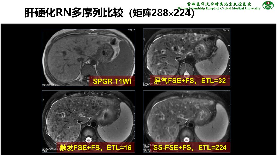 【PPT】肝脏MRI检查技术规范