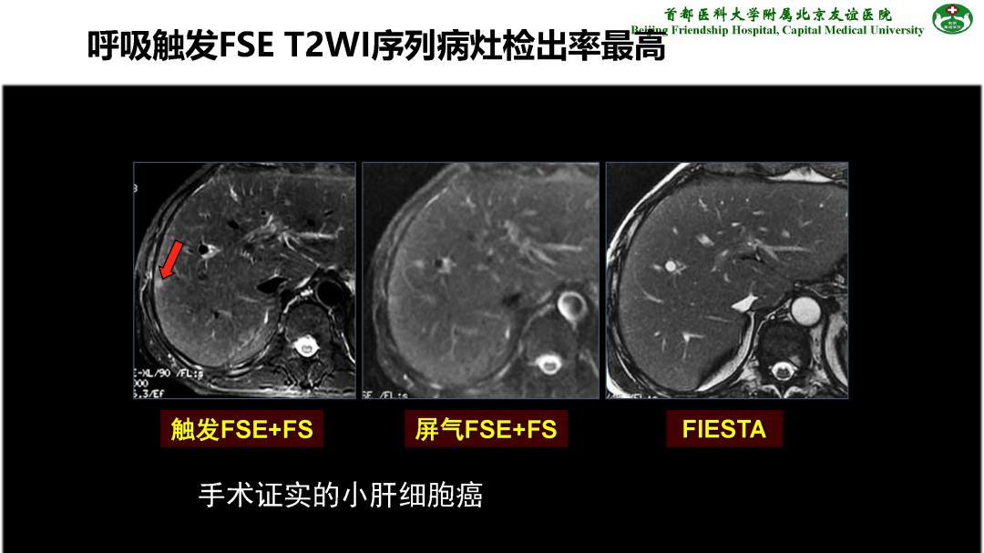 【PPT】肝脏MRI检查技术规范
