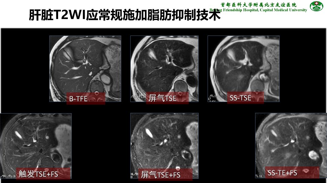 【PPT】肝脏MRI检查技术规范