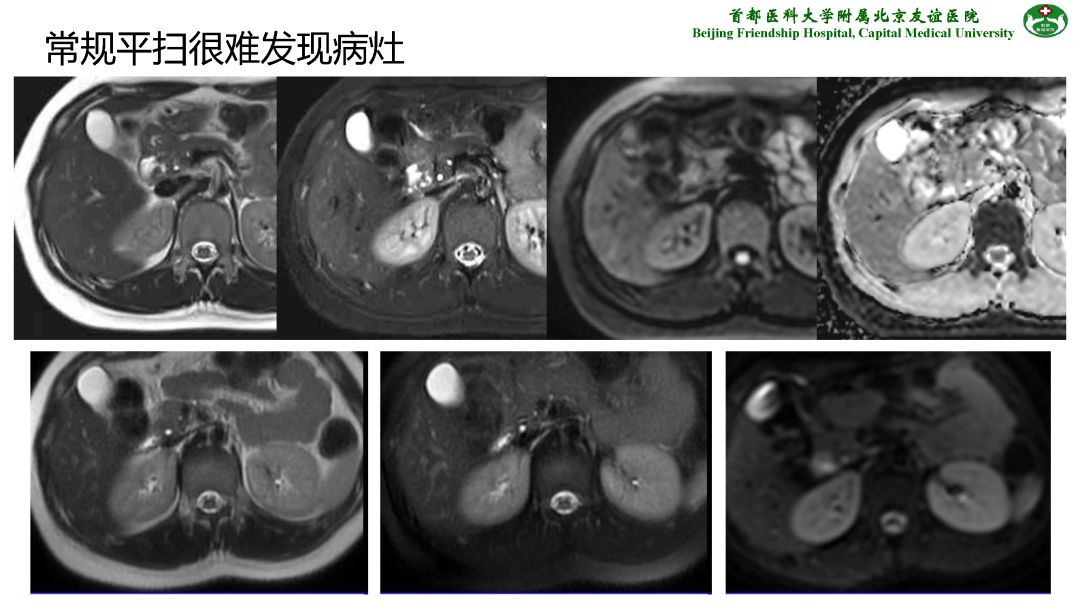【PPT】肝脏MRI检查技术规范
