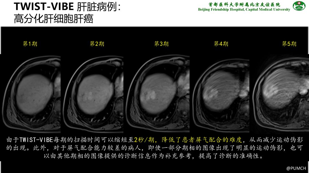 【PPT】肝脏MRI检查技术规范