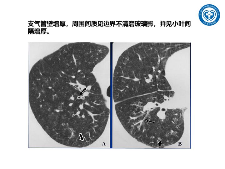 【PPT】一起家庭聚集性支原体肺炎病例汇报