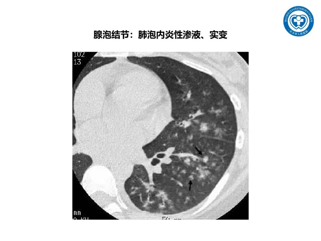 【PPT】一起家庭聚集性支原体肺炎病例汇报