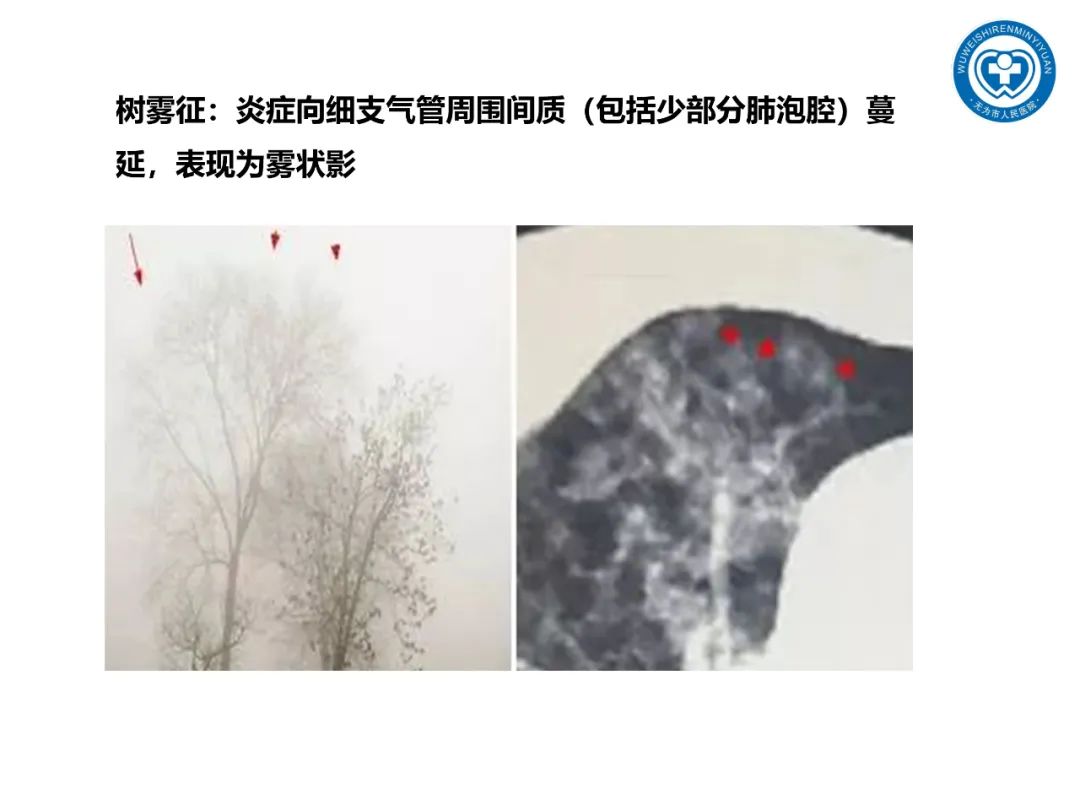 【PPT】一起家庭聚集性支原体肺炎病例汇报
