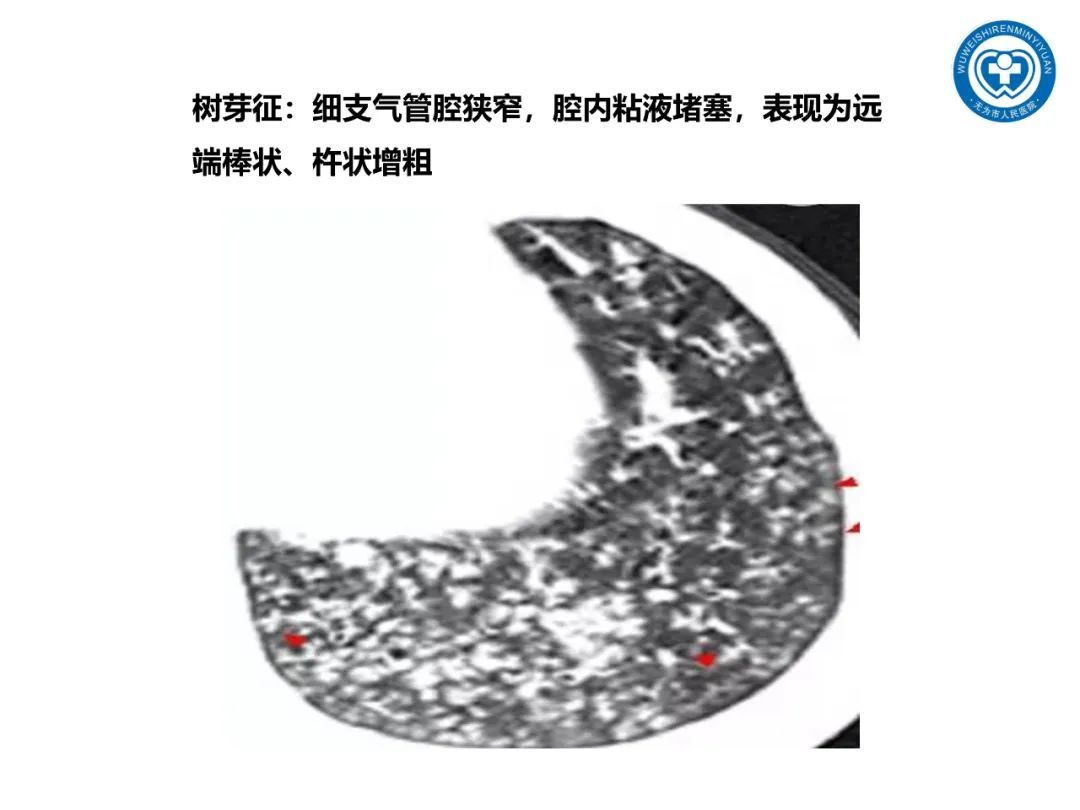【PPT】一起家庭聚集性支原体肺炎病例汇报