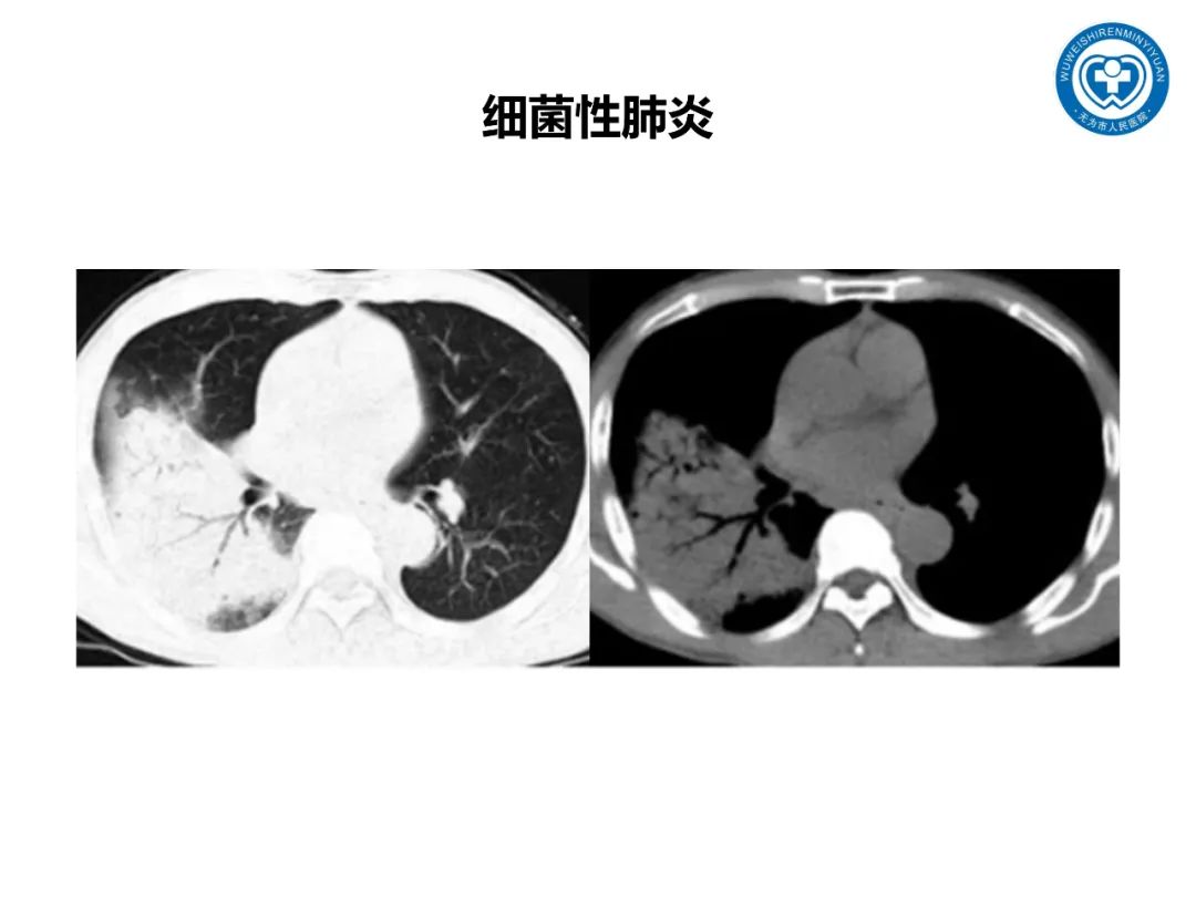 【PPT】一起家庭聚集性支原体肺炎病例汇报