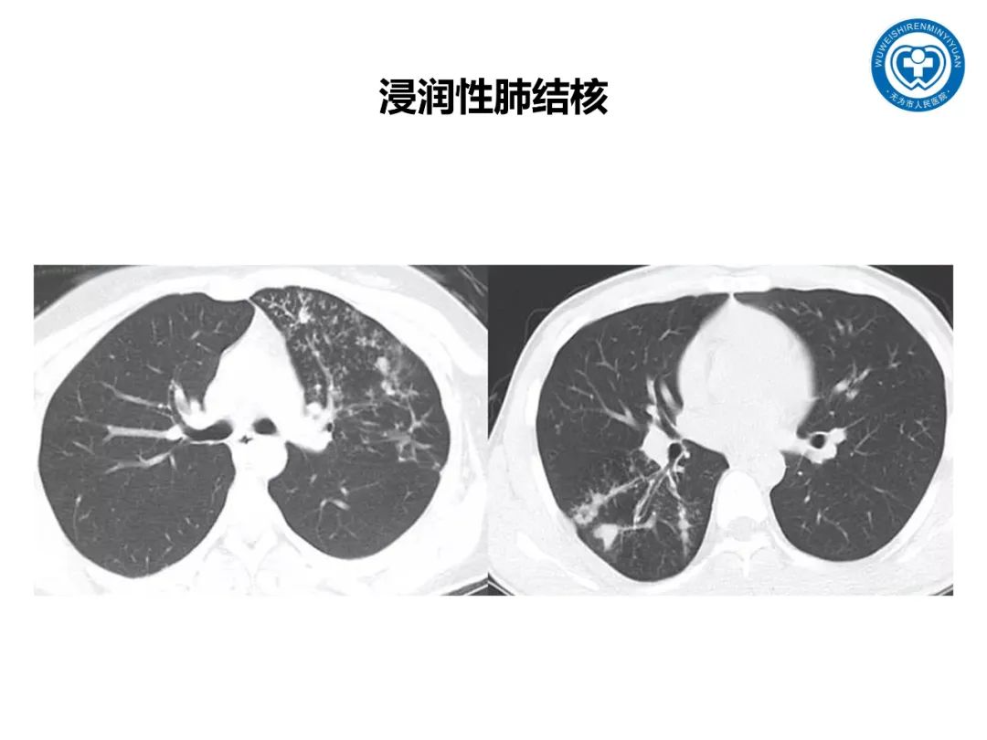 【PPT】一起家庭聚集性支原体肺炎病例汇报