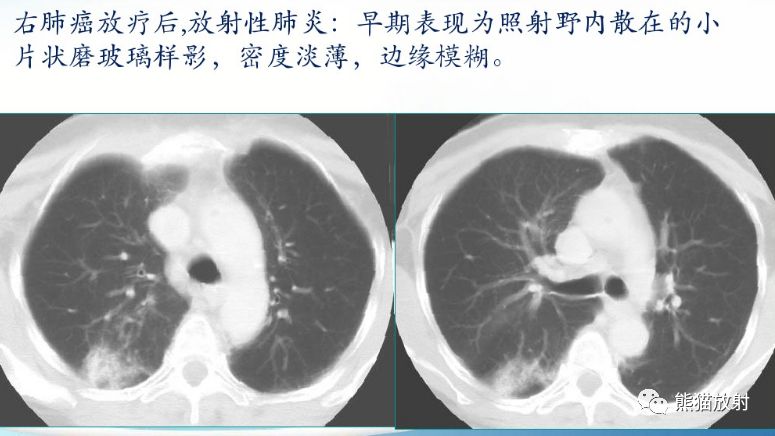 放射性肺炎CT表现、诊断要点 放射性肺炎CT表现、诊断要点