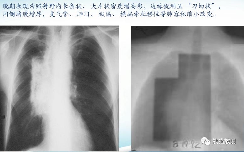 放射性肺炎CT表现、诊断要点 放射性肺炎CT表现、诊断要点