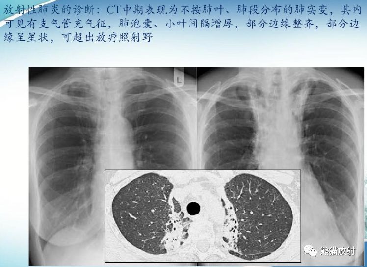 放射性肺炎CT表现、诊断要点 放射性肺炎CT表现、诊断要点