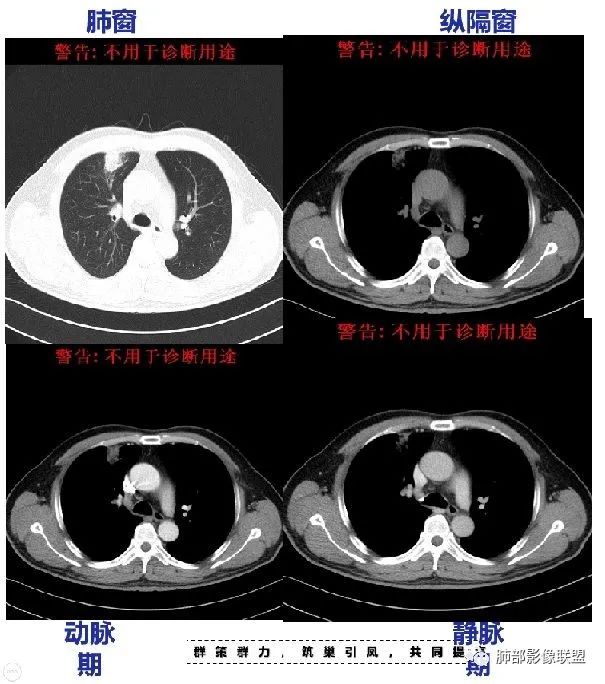 【病例】良恶一念间——肺部病变分析1例 【病例】良恶一念间——肺部病变分析1例