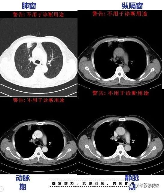 【病例】良恶一念间——肺部病变分析1例 【病例】良恶一念间——肺部病变分析1例