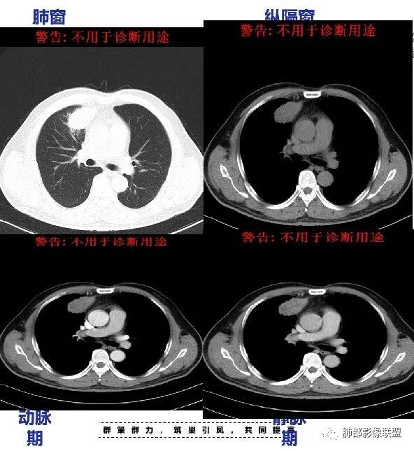 【病例】良恶一念间——肺部病变分析1例 【病例】良恶一念间——肺部病变分析1例