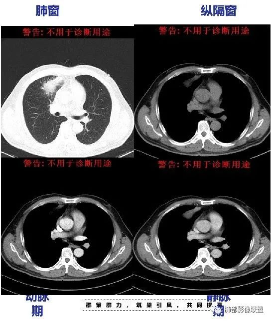 【病例】良恶一念间——肺部病变分析1例 【病例】良恶一念间——肺部病变分析1例