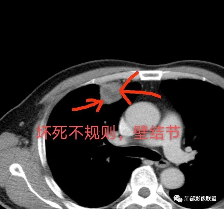 【病例】良恶一念间——肺部病变分析1例 【病例】良恶一念间——肺部病变分析1例