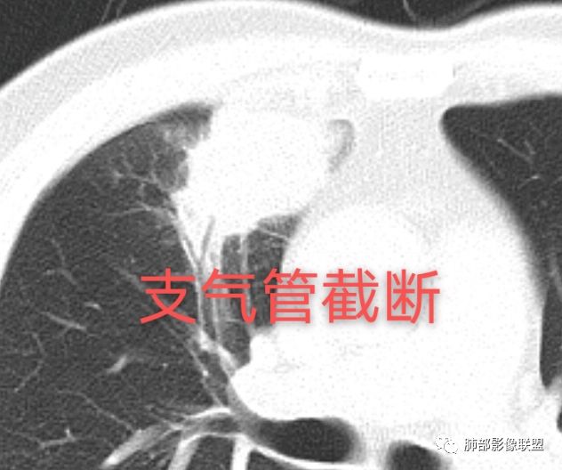 【病例】良恶一念间——肺部病变分析1例 【病例】良恶一念间——肺部病变分析1例