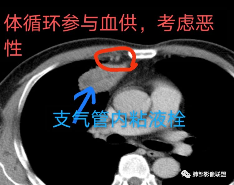 【病例】良恶一念间——肺部病变分析1例 【病例】良恶一念间——肺部病变分析1例