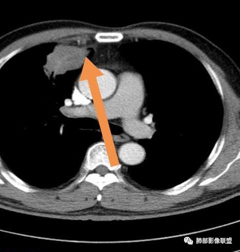 【病例】良恶一念间——肺部病变分析1例 【病例】良恶一念间——肺部病变分析1例
