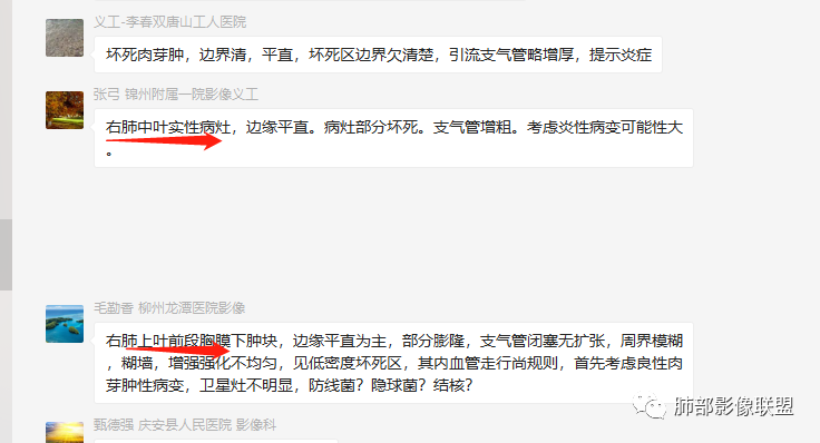 【病例】良恶一念间——肺部病变分析1例 【病例】良恶一念间——肺部病变分析1例