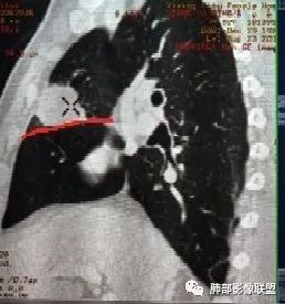 【病例】良恶一念间——肺部病变分析1例 【病例】良恶一念间——肺部病变分析1例