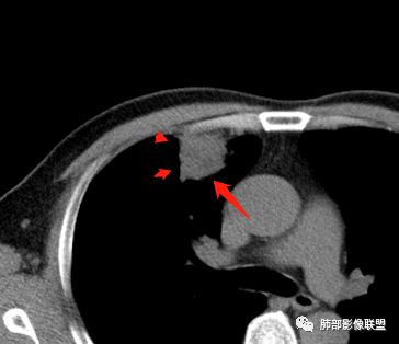 【病例】良恶一念间——肺部病变分析1例 【病例】良恶一念间——肺部病变分析1例