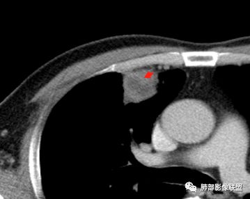 【病例】良恶一念间——肺部病变分析1例 【病例】良恶一念间——肺部病变分析1例