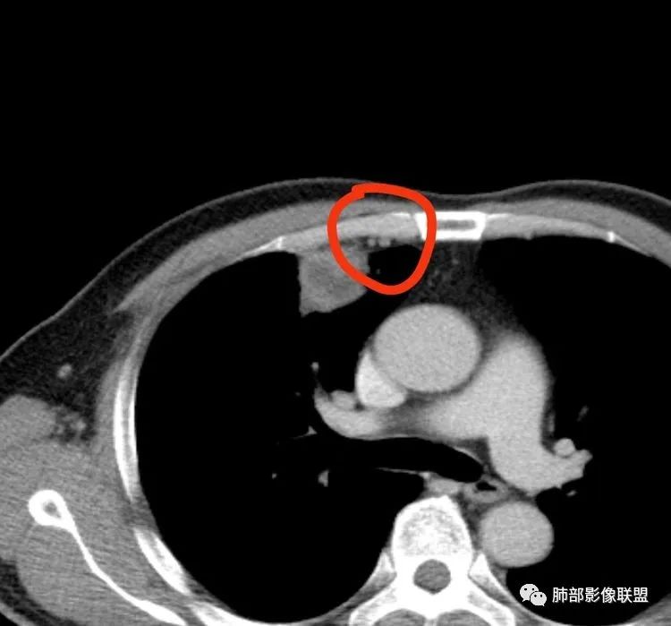 【病例】良恶一念间——肺部病变分析1例 【病例】良恶一念间——肺部病变分析1例