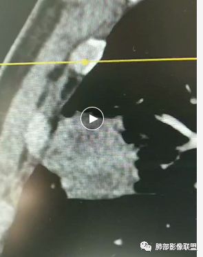 【病例】良恶一念间——肺部病变分析1例 【病例】良恶一念间——肺部病变分析1例