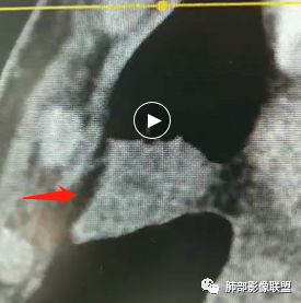 【病例】良恶一念间——肺部病变分析1例 【病例】良恶一念间——肺部病变分析1例