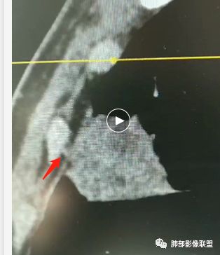 【病例】良恶一念间——肺部病变分析1例 【病例】良恶一念间——肺部病变分析1例
