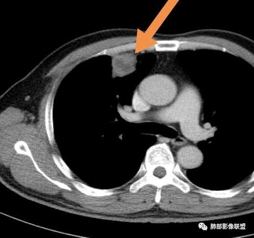 【病例】良恶一念间——肺部病变分析1例 【病例】良恶一念间——肺部病变分析1例