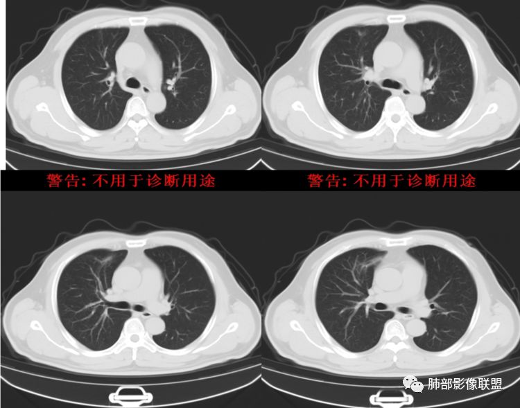 【病例】良恶一念间——肺部病变分析1例 【病例】良恶一念间——肺部病变分析1例