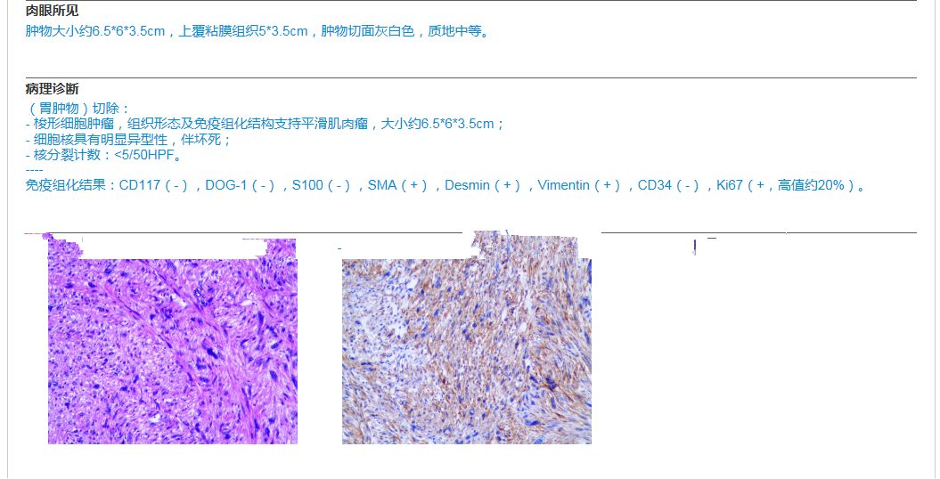 【病例】胃平滑肌肉瘤1例CT影像 【病例】胃平滑肌肉瘤1例CT影像