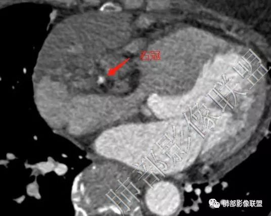 【病例】心包海绵状血管瘤1例CT影像 【病例】心包海绵状血管瘤1例CT影像