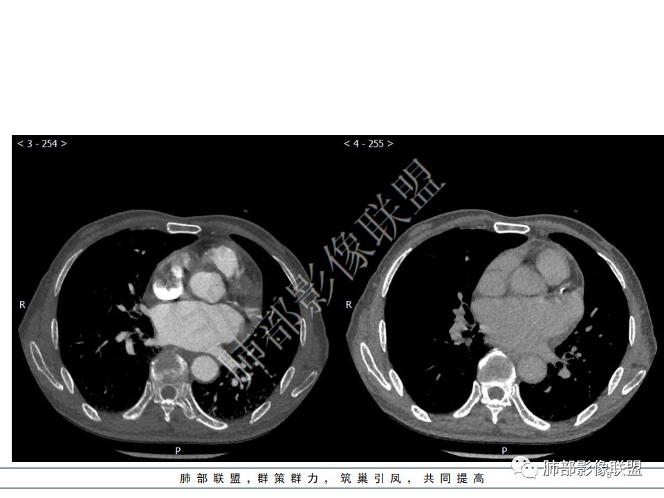 【病例】心脏血管肉瘤1例CT影像 【病例】心脏血管肉瘤1例CT影像