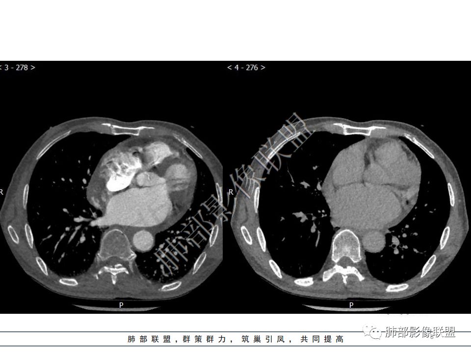 【病例】心脏血管肉瘤1例CT影像 【病例】心脏血管肉瘤1例CT影像