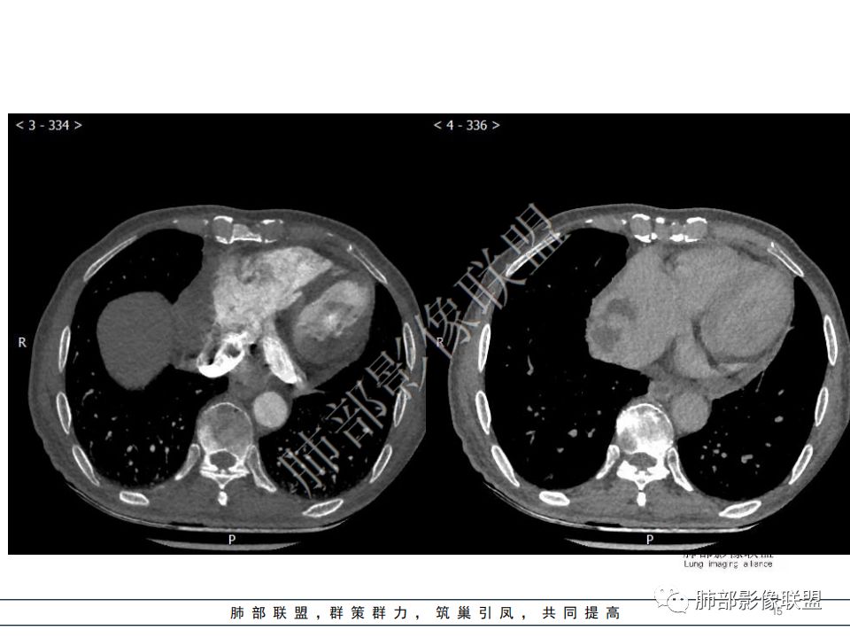 【病例】心脏血管肉瘤1例CT影像 【病例】心脏血管肉瘤1例CT影像