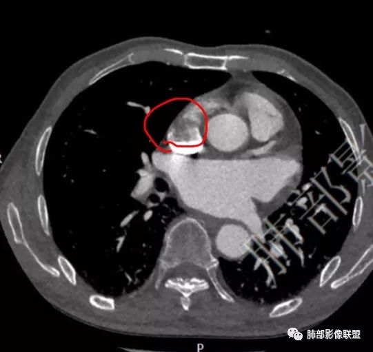 【病例】心脏血管肉瘤1例CT影像 【病例】心脏血管肉瘤1例CT影像