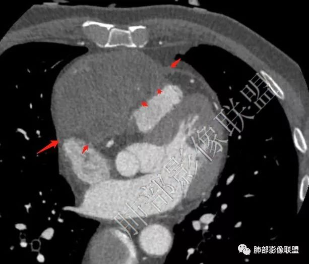 【病例】心包恶性间皮瘤1例CT影像 【病例】心包恶性间皮瘤1例CT影像