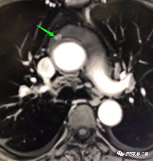 【病例】心包恶性间皮瘤1例CT影像 【病例】心包恶性间皮瘤1例CT影像