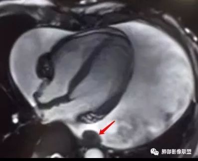 【病例】心包恶性间皮瘤1例CT影像 【病例】心包恶性间皮瘤1例CT影像
