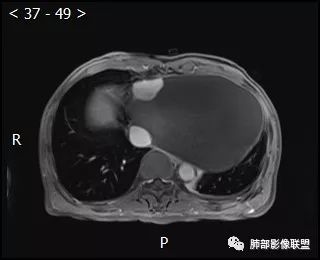 【病例】心包恶性间皮瘤1例CT影像 【病例】心包恶性间皮瘤1例CT影像