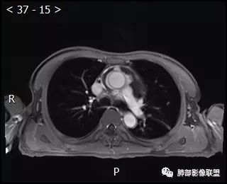 【病例】心包恶性间皮瘤1例CT影像 【病例】心包恶性间皮瘤1例CT影像