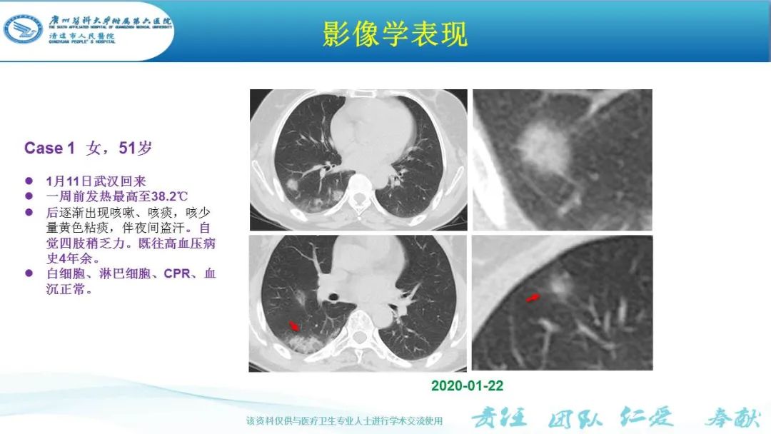 【PPT】新冠病毒肺炎影像学表现