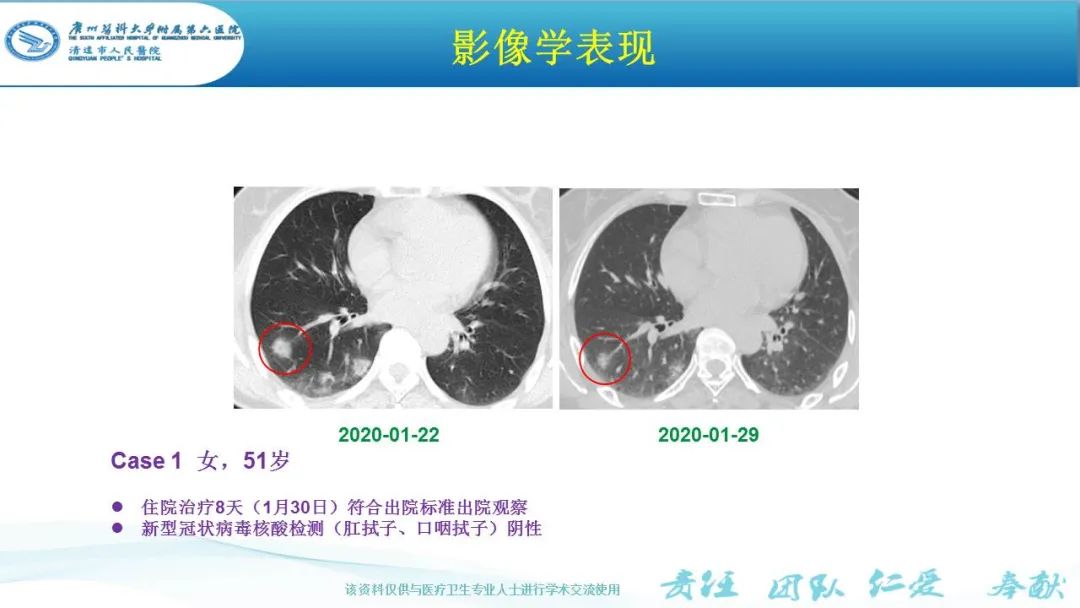 【PPT】新冠病毒肺炎影像学表现