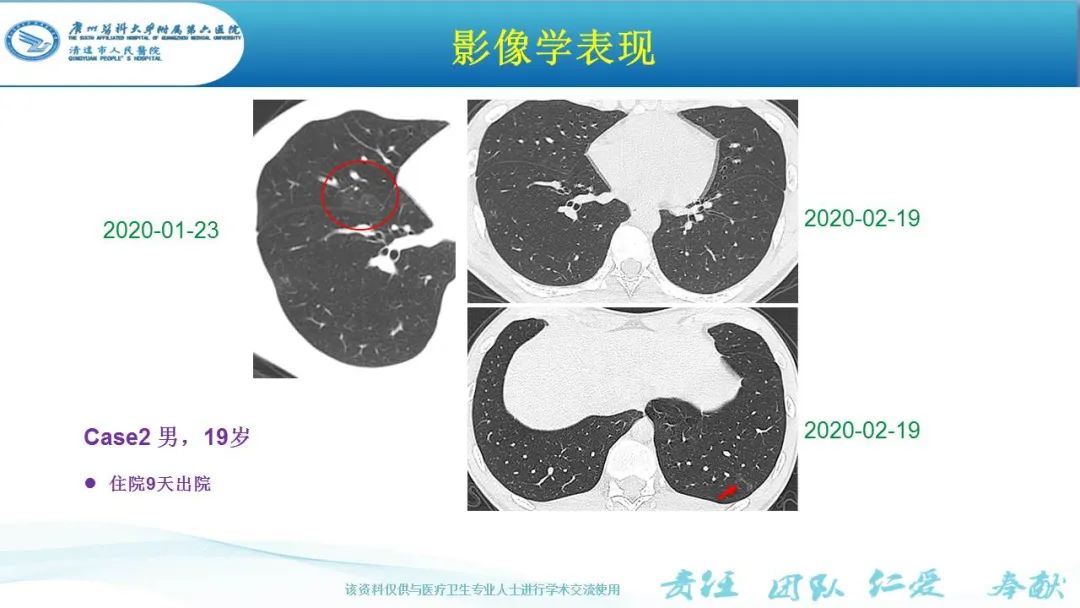 【PPT】新冠病毒肺炎影像学表现